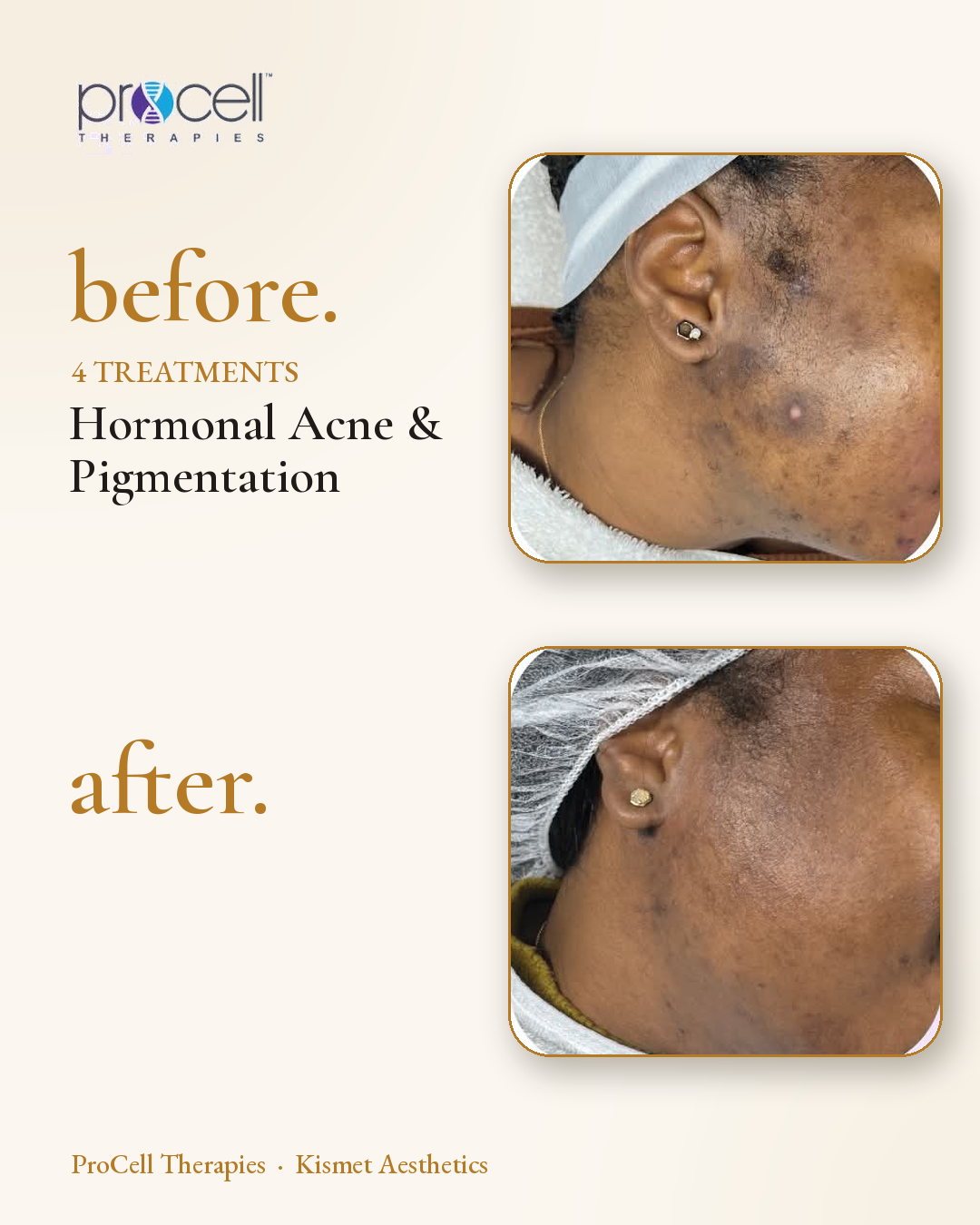 ProCell microneedling before and after — hormonal acne and pigmentation