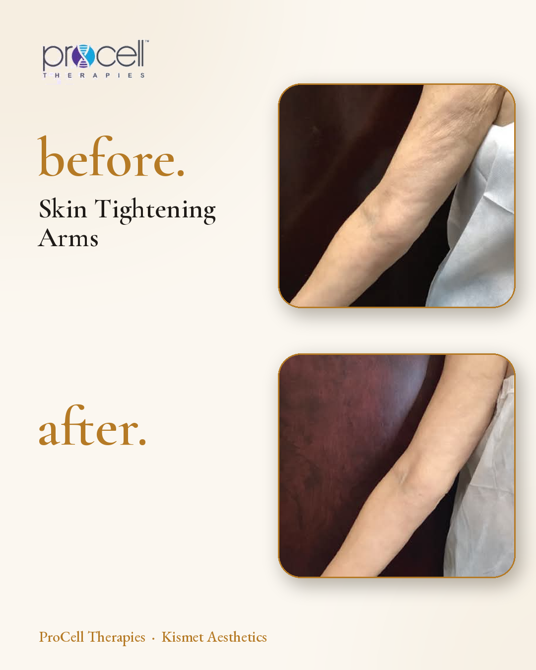 ProCell microneedling before and after — arm skin tightening