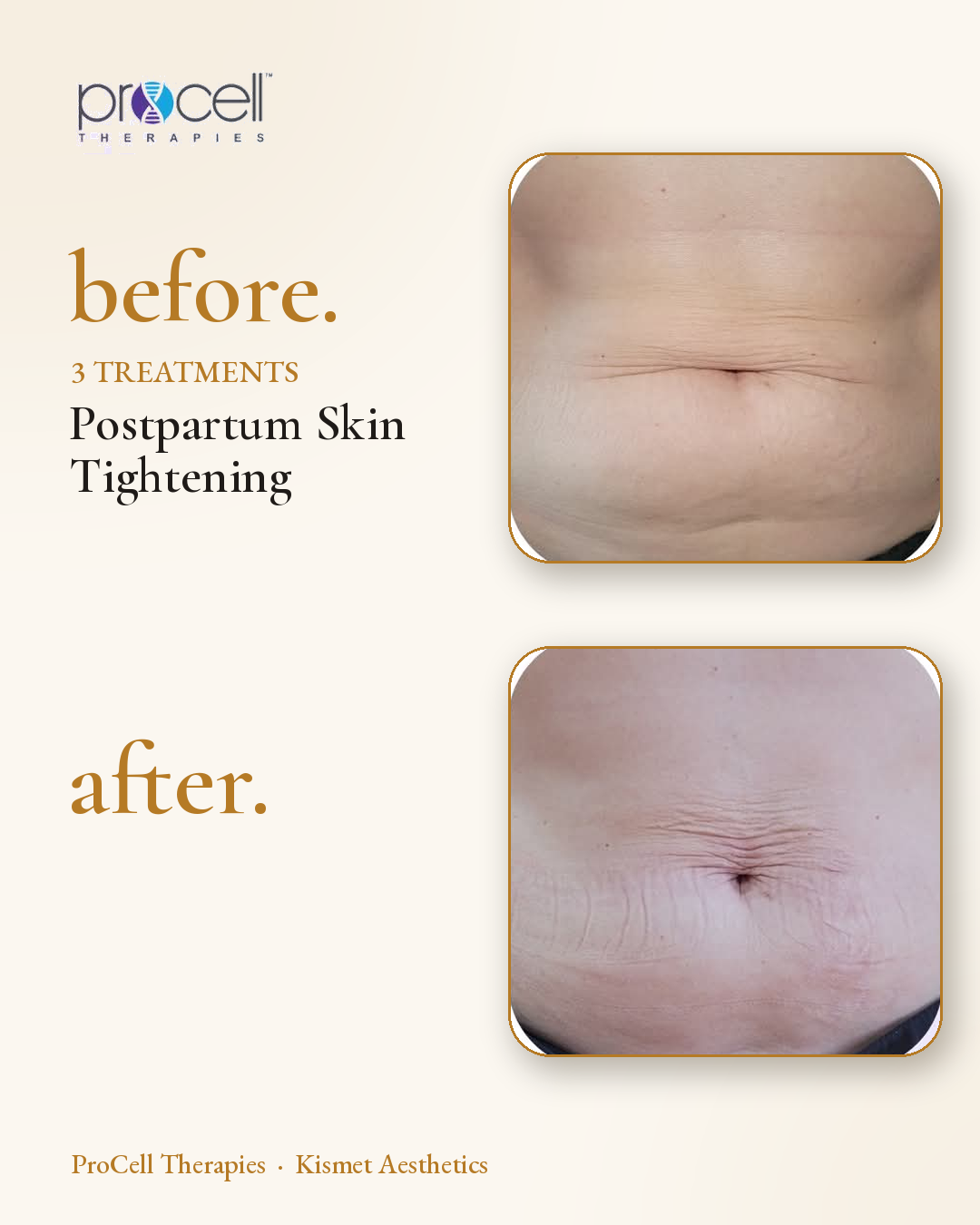 ProCell microneedling before and after — postpartum skin tightening