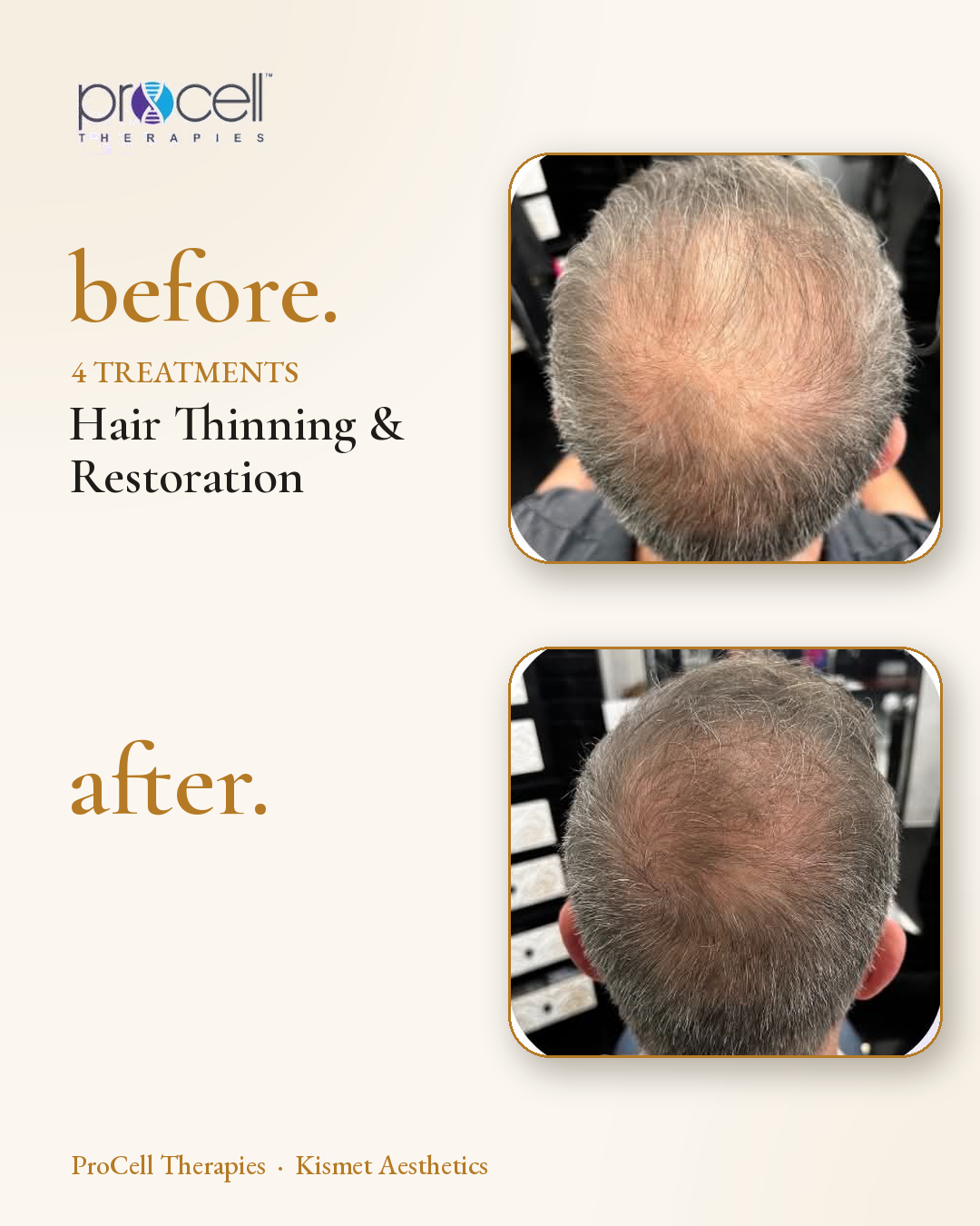 ProCell microneedling before and after — hair thinning and restoration