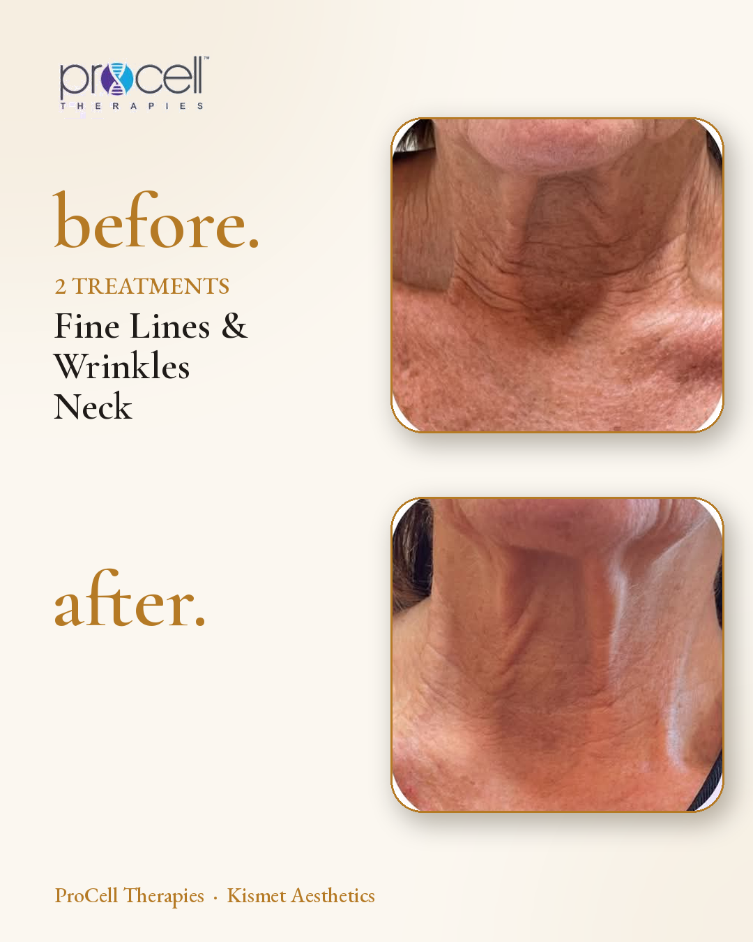 ProCell microneedling before and after — fine lines and wrinkles on the neck