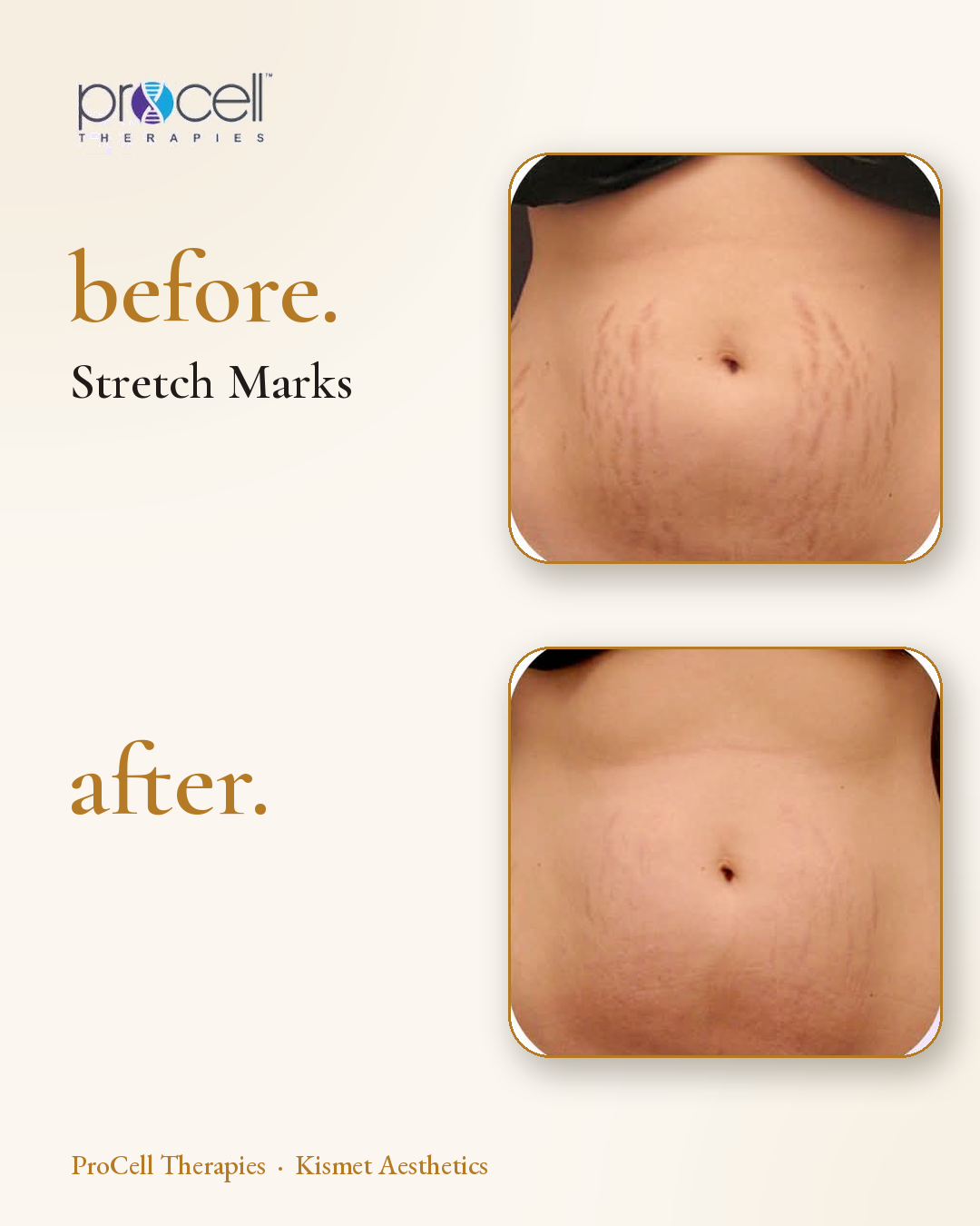 ProCell microneedling before and after — stretch marks